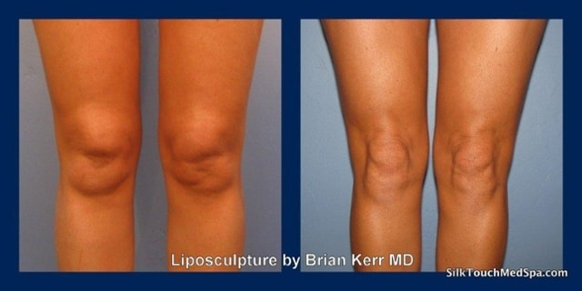 03liposuction smartlipo knees and ankles by brian kerr md boise idaho 1 1 | KNEE CALF AND ANKLE LIPOSUCTION