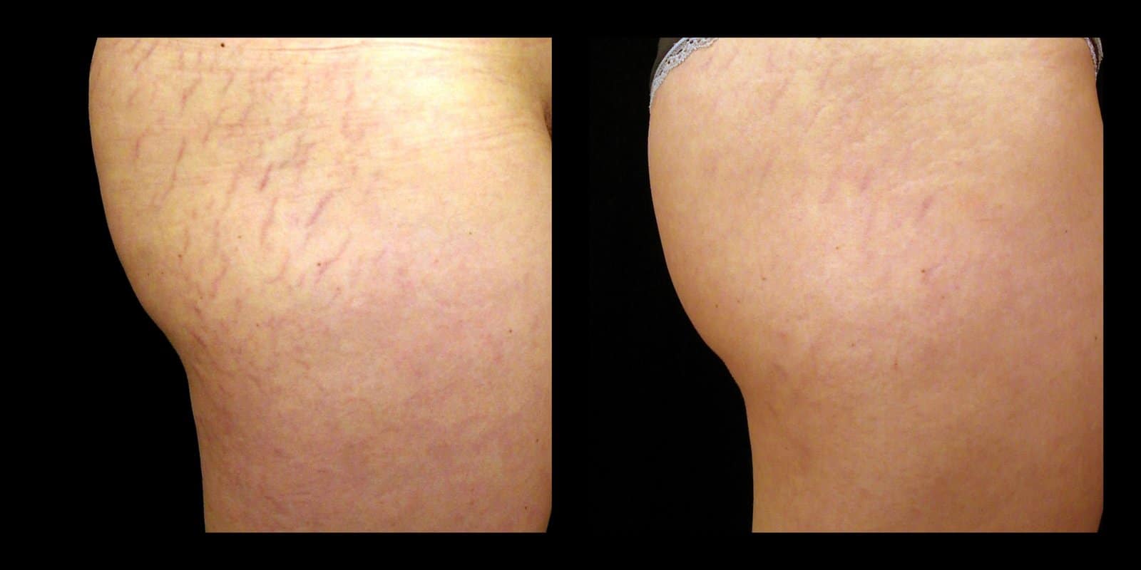 affirm stretch marks before and after