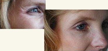 botox before after silk touch boise