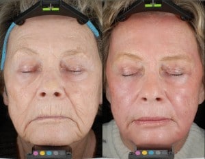 woman’s face and after dot therapy with less wrinkles around mouth after treatment