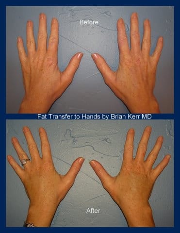 fat transfer hands 2009.10.15.091