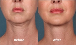kybella before and after pic boise 300x178 1
