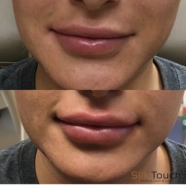 lip filler before and after1