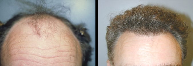 neograft before and after photos men boise