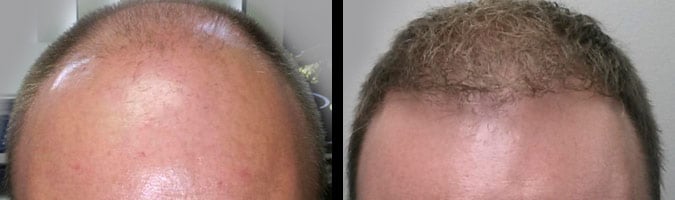 neograft before and after photos men boise3