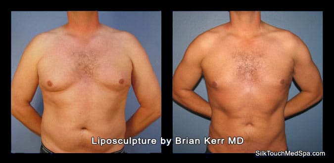 04liposuction smartlipo of male chest and abdomen by brian kerr md boise idaho