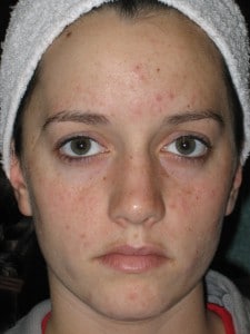 acne photo before acne photodynamic therapy boise 1 225x300 1