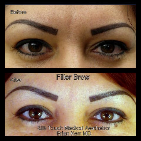 injectable fillers brow area silk touch med spa boise