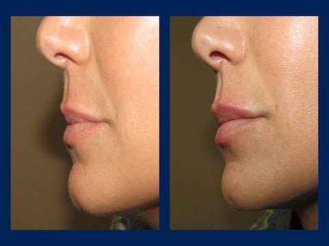 juvederm in boise before and after