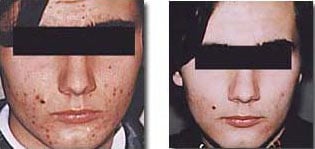 medical microdermabrasion before after silk touch med spa 1