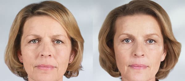 sculptra aesthetic before after silk touch med spa boise3