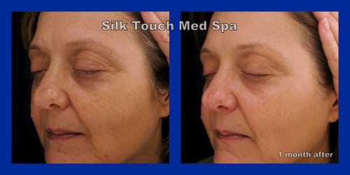 woman’s face before and after silk touch skin lightening peel