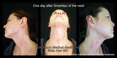 smartlipo laser lipo before after neck area woman silk touch med spa