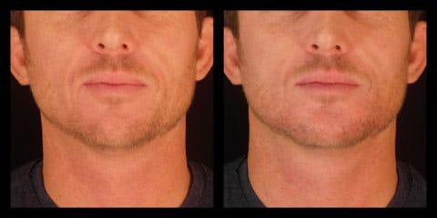 voluma injections before after chin augmentation silk touch med spa boise1
