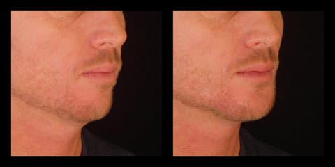 voluma injections before after chin augmentation silk touch med spa boise2