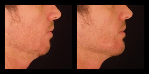 voluma injections before after chin augmentation silk touch med spa boise3
