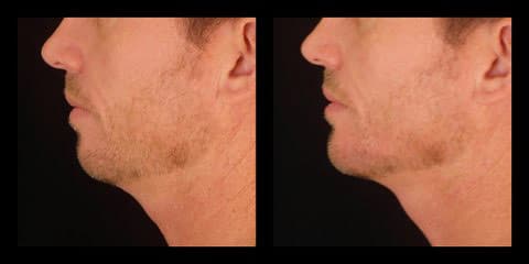 voluma injections before after chin augmentation silk touch med spa boise4