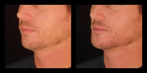voluma injections before after chin augmentation silk touch med spa boise5