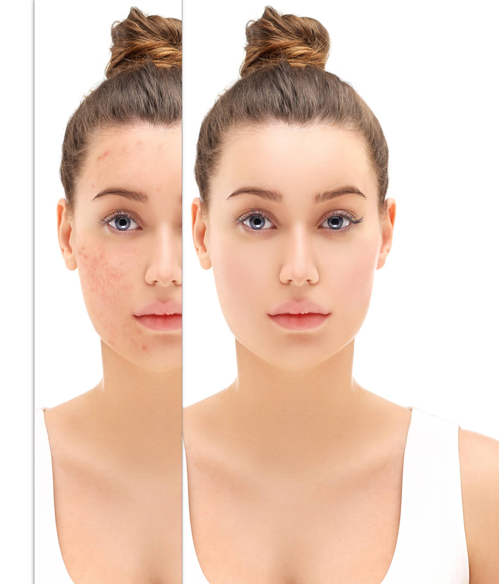 A before and after image set of a girl with acne and then her with clear skin