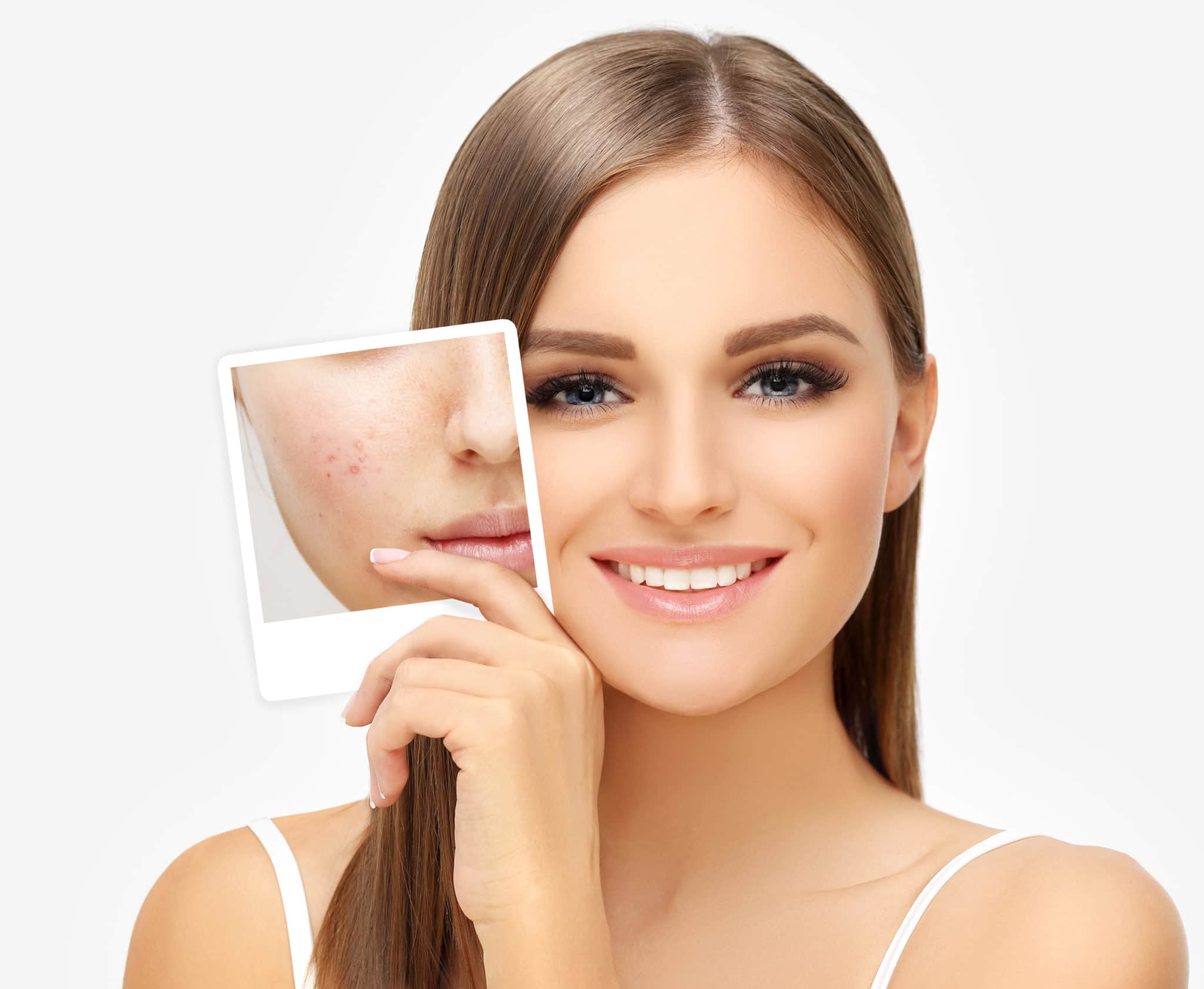 Portrait of girl with clear skin holding a picture of herself with acne problems.