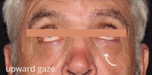 Lower Blepharoplasty With CO2 Laser Resurfacing