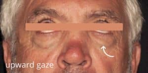 Lower Blepharoplasty With CO2 Laser Resurfacing