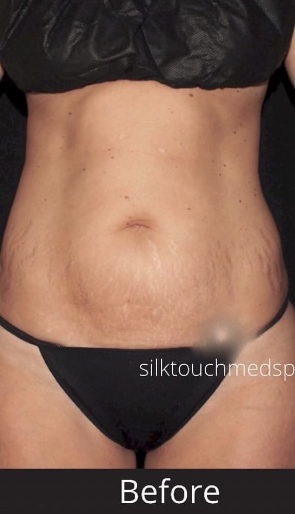 Liposuction With Mini Tummy Tuck