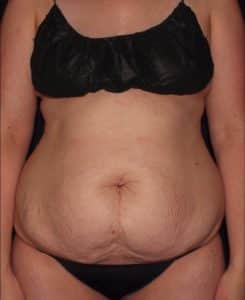 Tummy Tuck and Fat Transfer to Breast