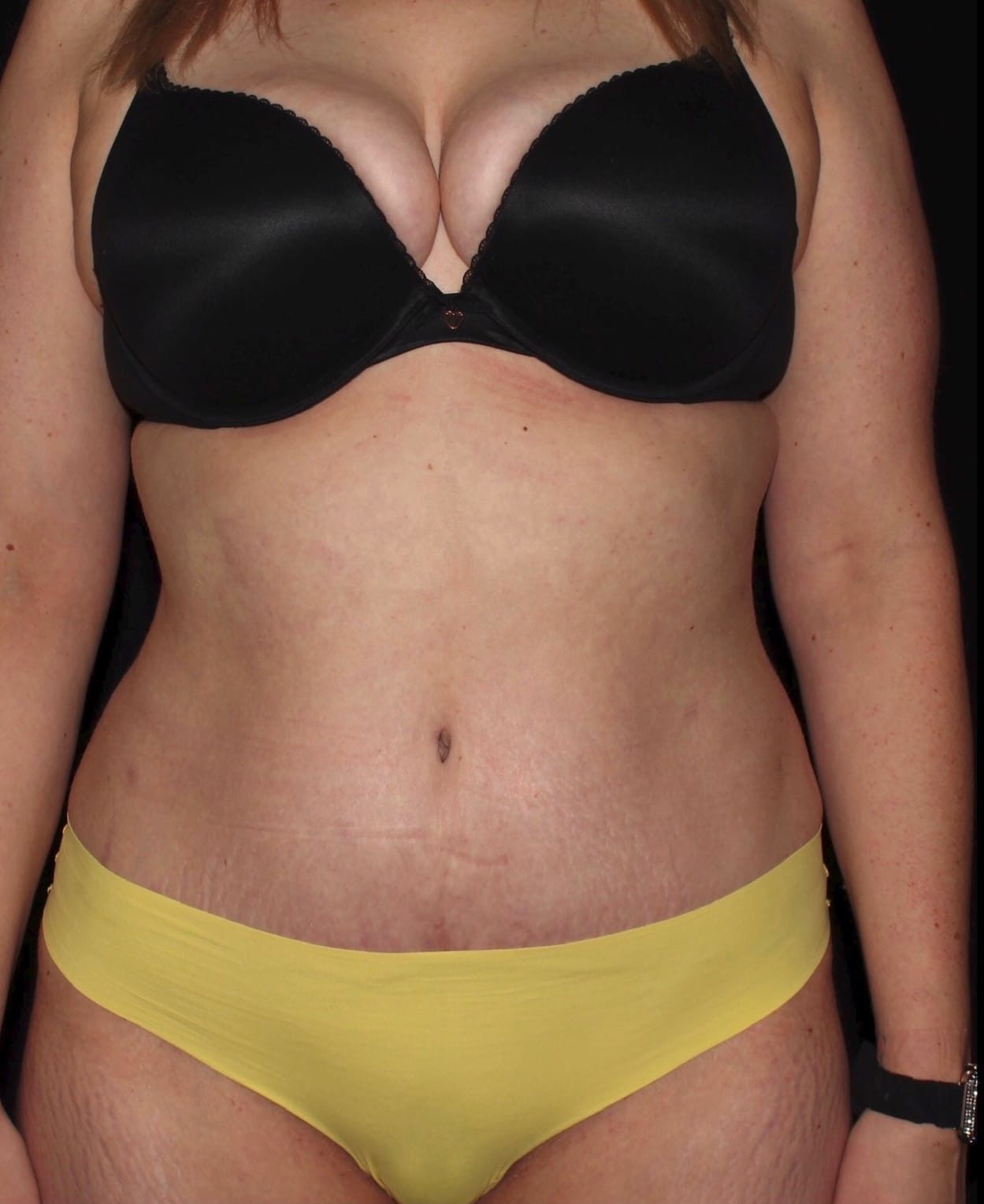 Tummy Tuck and Fat Transfer to Breast