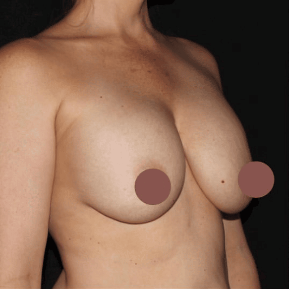 Breast Lift With Implant Exchange