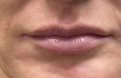 Lip Enhancement With Filler