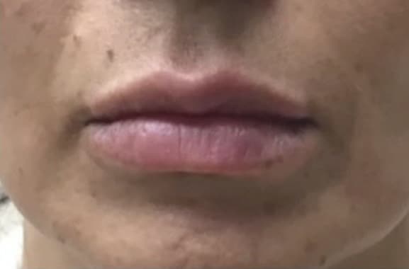 Lip Enhancement