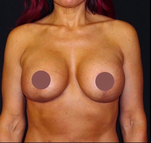Breast Lift With Implant Exchange