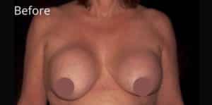 Breast Lift With Implant Exchange and Capsulectomy