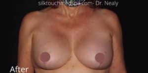 Breast Lift With Implant Exchange and Capsulectomy