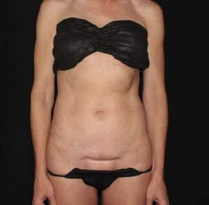 C-section Scar Correction By Using Liposuction and a Mini Tummy Tuck