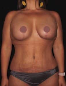Breast Lift With Implants and a Tummy Tuck