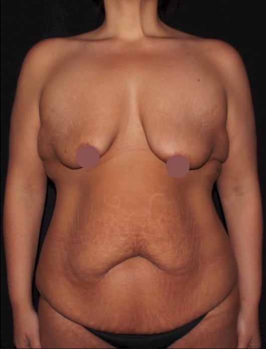 Breast Lift With Implants and a Tummy Tuck
