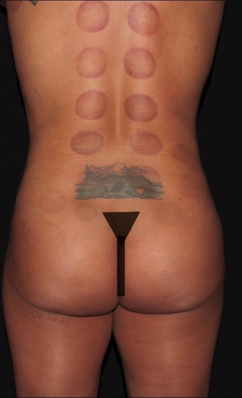 Lipo of the lower back, flanks and abdomen with a BBL
