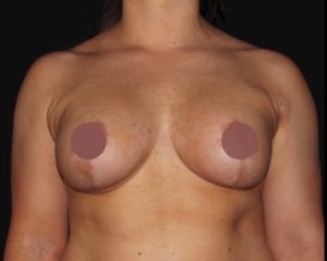 Breast Lift With Silicone Implant