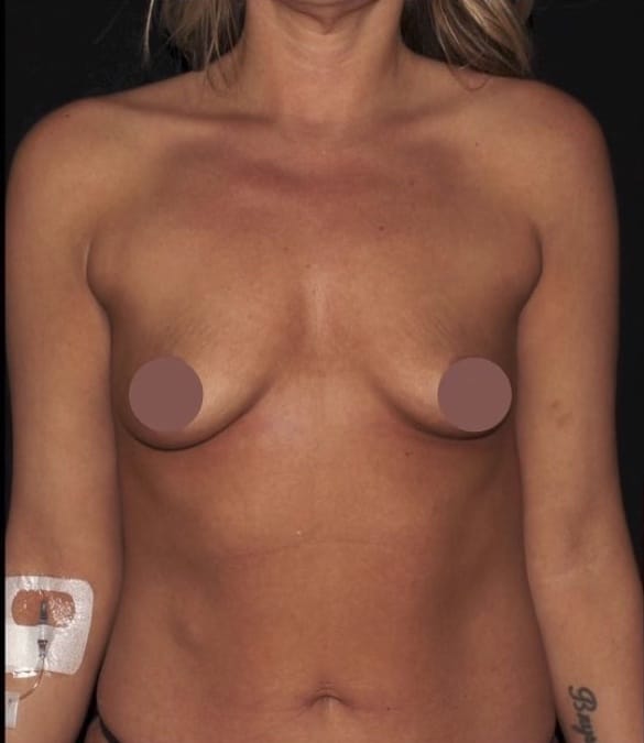 Breast Augmentation With Silicone Implants