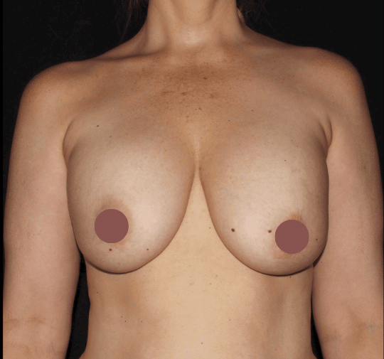 Breast Lift With Implant