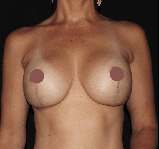 Breast Lift With Implant