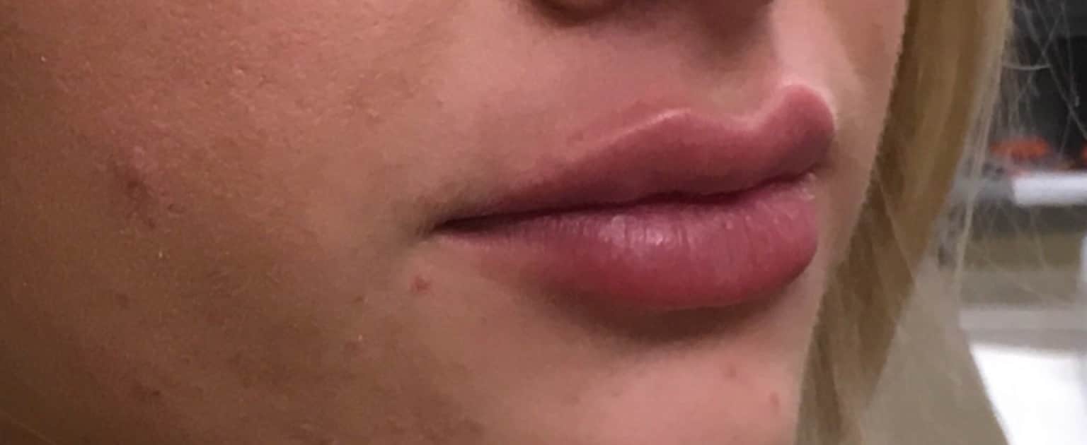 Lip Enhancement With Filler