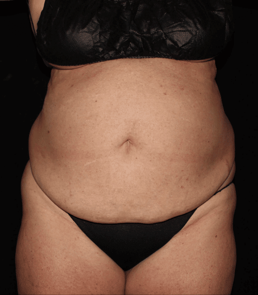 Liposuction and Mini Abdominoplasty