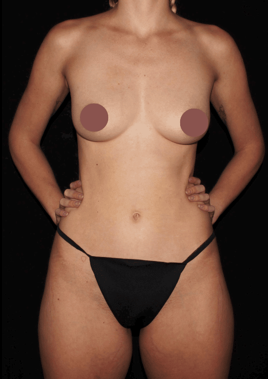 Fat Transfer To Breasts