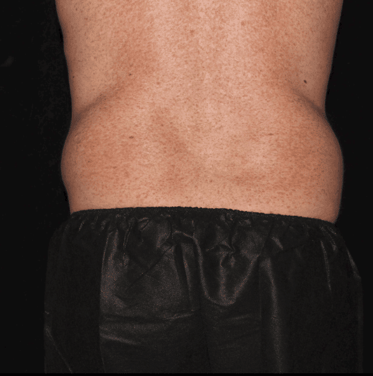 Liposuction of the Flanks