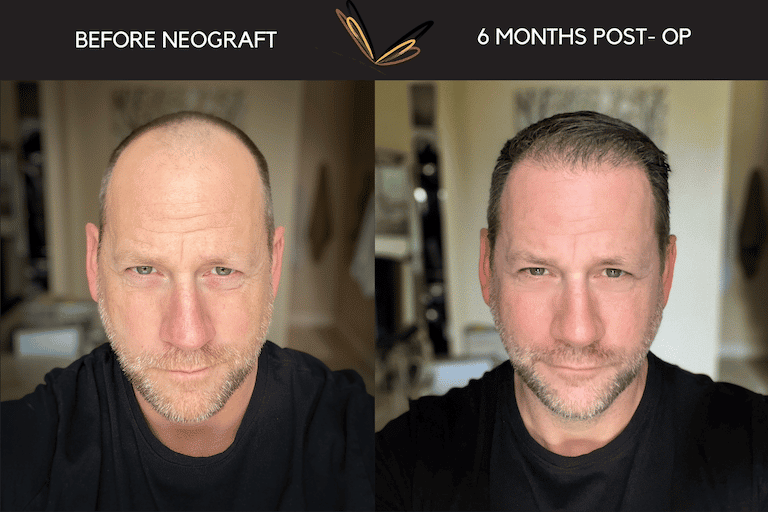 NeoGraft Hair Transplant Boise | Hair Restoration | Brian Kerr, Jason Nealy