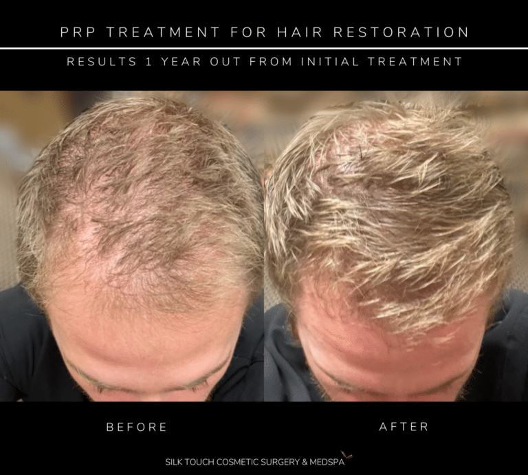 Before and after picture of Male patient showing significant hair growth after one PRP. Results are one year after intiial treatment.