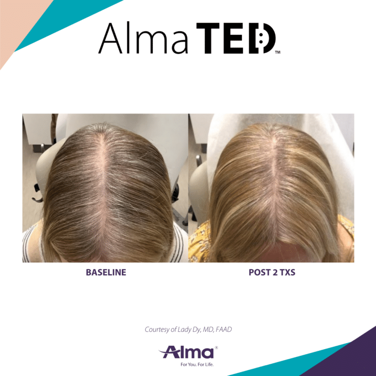 Alma Ted Hair Restoration Silk Touch